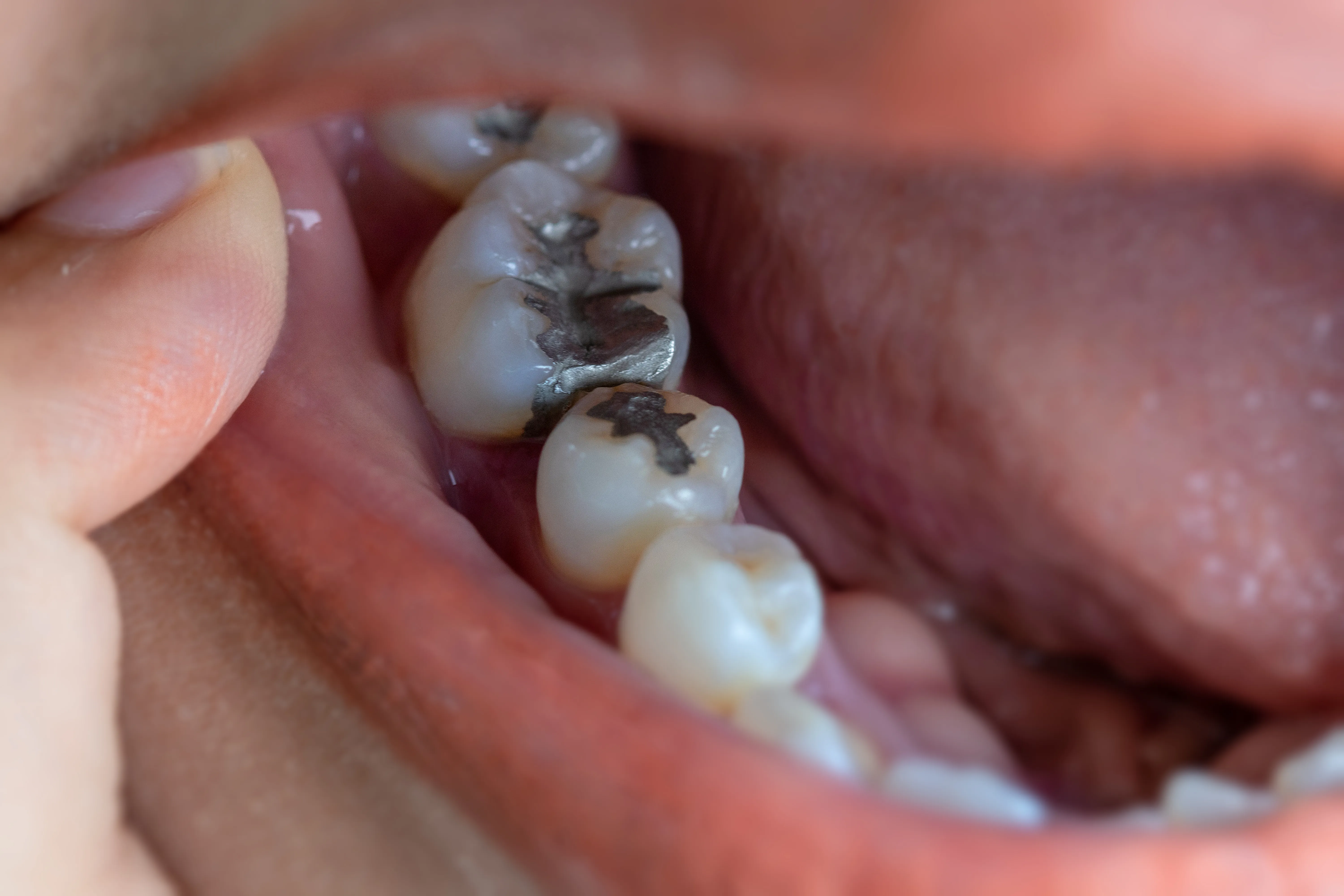 Tooth-colored filling placement at Studio One Dental